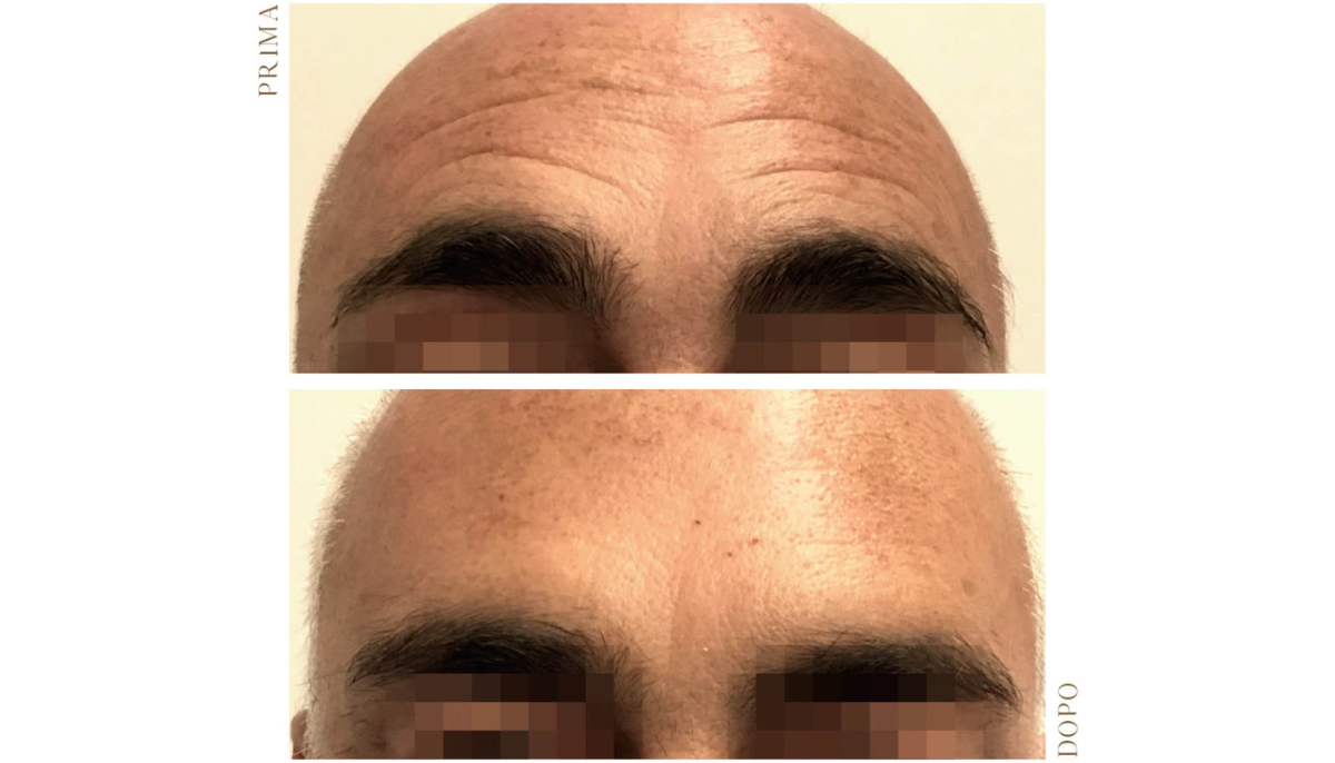 “Brotox”: il trattamento Botox per l’uomo